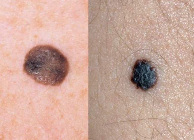 Medyczna ilustracja porównująca wygląd łagodnego znamienia z atypowym znamieniem (czerniakiem), pokazująca różnice w kształcie i kolorze.